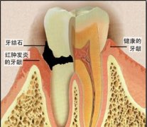 隐形女性不孕