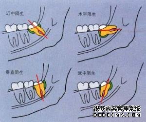 外阴炎拔除