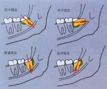 隐形女性不孕