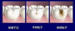 隐形女性不孕